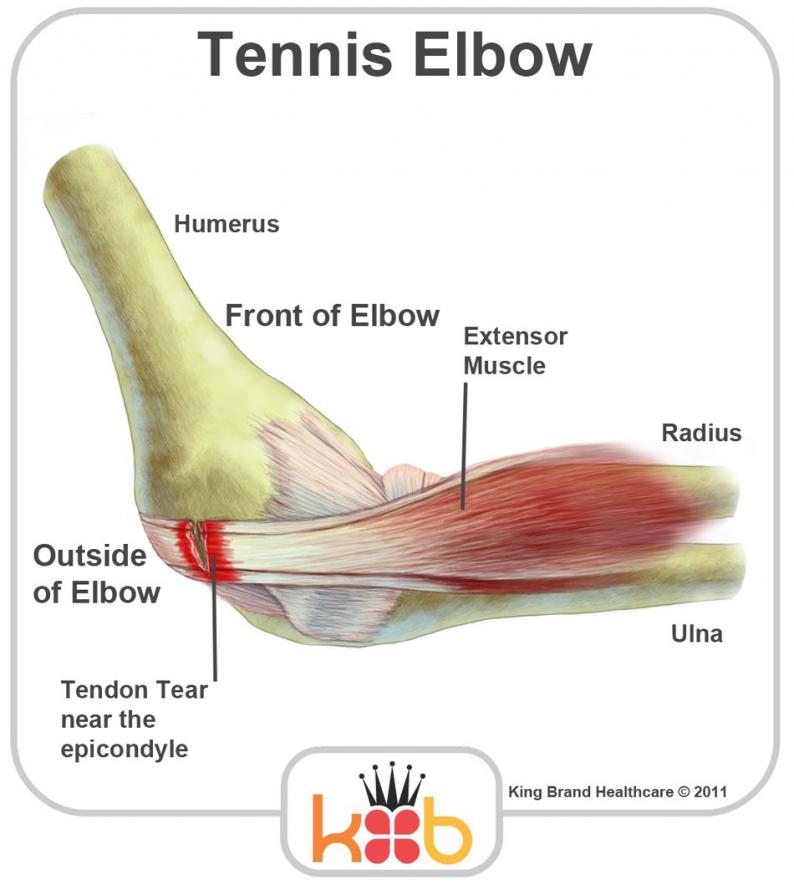 Tennis Elbow and Outer Elbow Pain